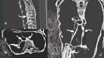 Compiled CT images of Unknown-Woman-A mummy torso in sagittal plane (A), axial plane (B), and coronal plane (C). Presence of high-density calcifications within the course of the right coronary (straight arrow) and left coronary arteries (curved arrows) in multiple planes indicate severe atherosclerosis of the coronary arteries.