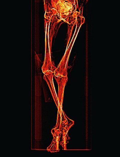 Scout CT scan shows the mummy's legs are partly flexed and crossing at the ankles, with the left leg above the right.