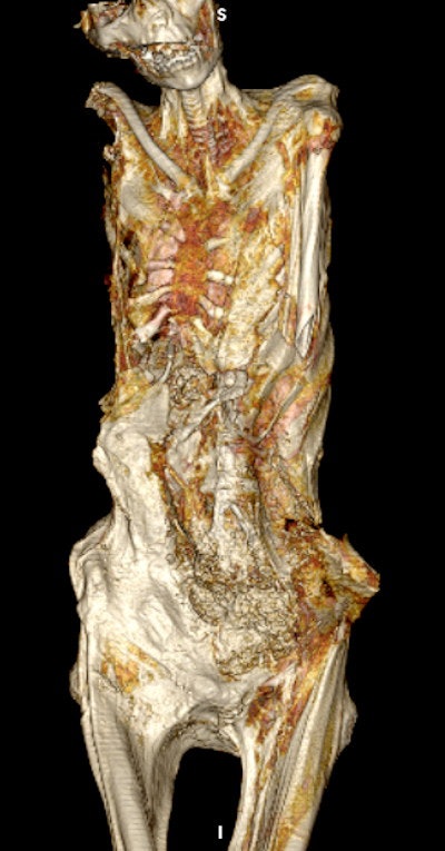3D CT image of the upper body of the mummy shows the gaping left inguinal evisceration incision. The disrupted anterior abdominal wall (likely inflicted by tomb robbers) reveals embalming material packs within the body cavity.