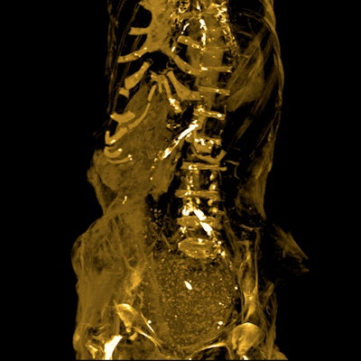 Maximum intensity projection image of the mummy's torso shows the arteries and tissues.
