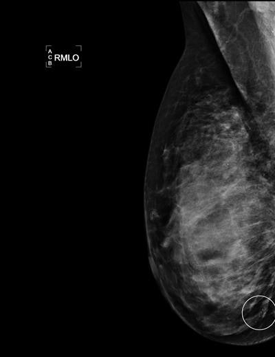 Mammogram shows a cluster of calcifications in a 49-year-old woman with an invasive 4-mm ductal breast cancer that had a true positive assessment by the first reader. Image courtesy of Dr. Mattie Salim.