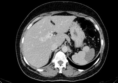 Caudate lobe hypertrophy in a patient with portal cavernoma. If suspected, a follow-up CT may be done to change the association between the rib/diaphragm and adjacent liver at a different inspiration level or with the patient in a decubitus position. All images courtesy of Drs. A.V. Neagu and C.-I. Betianu, originally presented at ECR 2020.