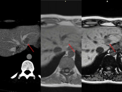Multifocal fatty liver with no obvious relationship to vascular flow. CT scan shows multiple regions of hypoattenuation on unenhanced CT and portal phase (arrow). When the same patient underwent an MRI scan for follow-up, there was no restricted diffusion. Gradient-echo imaging demonstrates intracellular fat with a drop of signal on out-of-phase images.