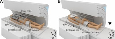 A group of Russian scientists has proposed a device that can be used to update existing MRI scanners, allowing for breast MRI to be conducted using standard scanners without specialized radiofrequency receive coils. Image courtesy of Nature Communications.