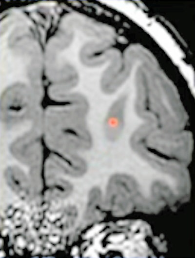 (Above) MRI shows an area of bright T1 signal indicating abnormality. (Below) A transmantle sign, a clear example of a small focal cortical dysplasia (FCD), can be visualized on the MRI. All images courtesy of Dr. Ellen Grant.