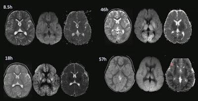 DWI and the ADC image shows a 2-year-old child who had choked on a candy. DWI and ADC images revealed only slight necrosis at 30 minutes after injury. However, the child was pronounced dead four days later, as the brain necrosed and swelled. Images show progress of delayed cell death