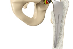 2020 08 12 21 57 7364 3 D Hip Replacement 400