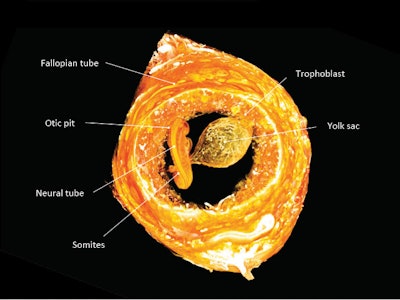 An intact ectopic pregnancy in the fallopian tube was imaged by contrast-enhanced micro-CT at 3-µm isotropic resolution, revealing a 6-week-gestation human embryo 3 mm in length. The embryo and its yolk sac are completely surrounded by trophoblast (developing placenta) and the fallopian tube. The embryo is shown from the dorsal side, with the developing neural tube facing the viewer. Image courtesy of the RSNA.