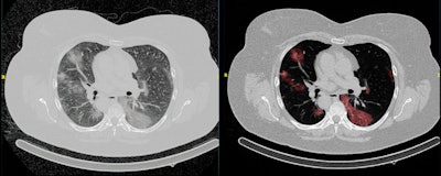 Example of an automated segmentation tool that shows the original image (left) and the predicted segmentation (right). The tool is being used in the Imaging Covid-19 AI research project to develop a deep learning-based model for the automated detection of COVID-19 infection on chest CT and for quantifying lung involvement. The algorithm was trained on a first run of around 1,000 CT scans. Figure courtesy of Quibim.
