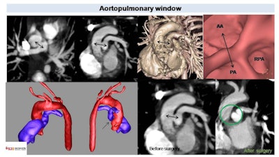 CT in 2-year-old patient with Tetralogy of Fallot. Note the communication between the main pulmonary artery (PA) and ascending aorta (AA) (black arrows) corresponding to the aortopulmonary window. Volume rendered and endoscopic images show vessel distribution at this level. Postsurgical image depicts absence of communication between the aortic and pulmonary lumen (green circle). RPA = right pulmonary artery.