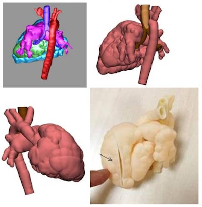 3D printed model of pulmonary valve agenesis in a newborn obtained from a 3D model created with CT images. Note the complex cardiovascular anatomy and relationship between vessel and airways. The surgeon can observe the interior ventricular cavity by means of a cut made in the ventricle surface (arrow) and can then decide on the most suitable surgical treatment or pulmonary prosthesis. All images courtesy of Hospital Sant Joan de Déu, Barcelona.
