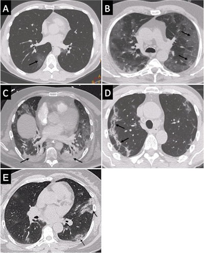 Typical images from five different patients who were COVID-19 positive on a virology test: ground-glass opacity (A), crazy paving (B), posterior lung consolidations (C), subpleural bands of consolidations (D), and reversed halo sign (E). Images courtesy of European Radiology.