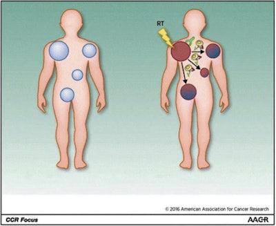 Researchers are studying how treating a single tumor with radiation, or radiation plus other treatments, may stimulate an immune response against tumors elsewhere in the body -- a response known as the abscopal effect. Courtesy of the NCI. Adapted from Clinical Cancer Research, September 2016.