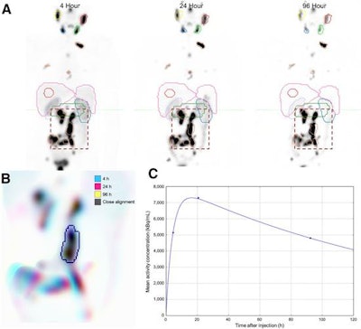 (A) Initial coarse alignment of full image volume for serial four-, 24-, and 96-h quantitative SPECT images. (B) Output of focused image registration based on contour-defined mask (dashed region of serial maximum-intensity projections in A). Three-color maximum-intensity projection is used to verify alignment for serial quantitative SPECT images, with 3D contour region highlighted. Black indicates good alignment whereas color-fringing shows areas with spatial offset. (C) Three-phase exponential curve is generated and parameters are used for subsequent population analysis. Image courtesy of SNMMI.