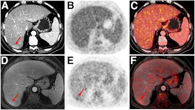 Indeterminate lesion on PET/CT classified by PET/MRI for 53-year-old man with lung cancer. Contrast-enhanced CT (A), PET (B), and fused F-18 FDG PET/CT (C) images are displayed in comparison with contrast-enhanced T1-weighted MRI (D), PET (E), and fused F-18 FDG PET/MRI (F) images. In CT (A), hyperdense, subcentimeter liver lesion (arrows) in segment VII is suggestive of transient hepatic attenuation difference or small hemangioma. As malignancy cannot be excluded, it needs further investigation. On PET/MRI, lesion is clearly classified as metastasis because of contrast enhancement and tracer uptake due to later acquisition time point. Follow-up CT confirmed diagnosis after 78 days. Image courtesy of the Journal of Nuclear Medicine.