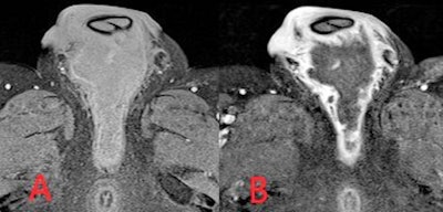 Axial fat-saturated T1-weighted MR images precontrast (A) and postintravenous contrast (B) administration. An intermediate/low intensity defined collection is demonstrated within the perineum. Avid peripheral mural rim-enhancement is seen with nonenhancing internal abscess contents.