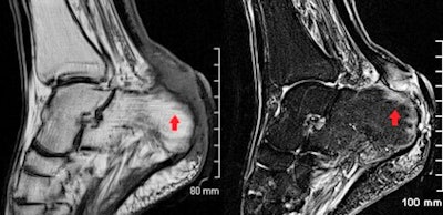 MRI is the imaging investigation of choice in osteomyelitis and other bone and joint infections. Sagittal T1-weighted (left) and short-tau inversion recovery (STIR) (right) images demonstrate osteomyelitis of the posterior aspect of the calcaneus. Cortical erosion and loss of the normal T1 hypointense rim at the bone edge is seen on the T1 image. There is high STIR signal and corresponding low T1 signal of the posterior calcaneus representing bone edema (red arrow) and overlying soft tissue inflammation is also seen. Images courtesy of Insights into Imaging.