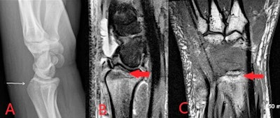 Images from an intravenous drug user who presented with wrist pain and swelling. Lateral radiograph (A) shows a linear lucency with cortical disruption at the dorsal aspect of the distal radius (white arrow). In the absence of a history of trauma, this was consistent with inadvertent direct injection to the bone. Associated early osteomyelitis is seen on MRI with sagittal STIR (B) showing a linear region of high signal with corresponding hypointense signal on the coronal T1 image (C).