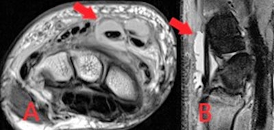 Axial proton density weighted (A) and sagittal STIR (B) MR images from the same patient as previous figure, demonstrating large volume fluid within the extensor compartment tendon sheaths at the wrist in keeping with septic tenosynovitis associated with injected drug use.