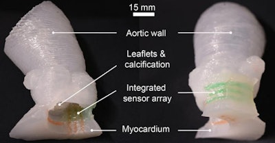 Patient-specific 3D-printed aortic root models with integrated 3D-printed soft sensor arrays can be used to improve planning of TAVR procedures. Images courtesy of the McAlpine Group, University of Minnesota.