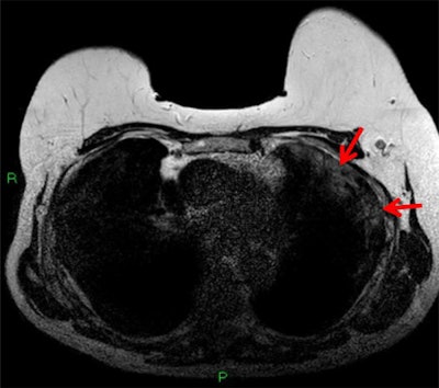 T2-weighted MRI depicting subpleural high T2 signal intensity (red arrows). All images courtesy of Dr. Anmol Malhotra.
