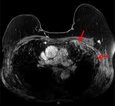 T1-weighted postcontrast fat-saturated MRI depicting subpleural consolidation enhancement (red arrows).