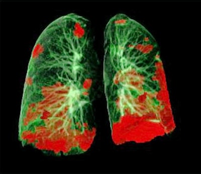CT scan of patient's lungs showing COVID-19 damage in red. Image courtesy of Dr. Gerlig Widmann and team, department of radiology, Medical University of Innsbruck.