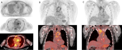 F-18 FDG PET/CT in a 59-year-old male patient with aortic valve infective endocarditis caused by Escherichia coli. He had fever and diffuse articular pain. He was previously diagnosed with ascending aorta aneurism, aneurism of the Circle of Willis, thoracoabdominal aortic aneurysm, and finally type A aortic dissection. History of aortic valve prosthesis infectious endocarditis (Staphylococcus epidermidis) treated with antimicrobial therapy. PET/CT images confirm infectious endocarditis, showing F-18 FDG uptake at the aortic valve infective prosthesis (A, from top to bottom nonattenuated PET, attenuated PET, and fused PET/CT). Additionally, F-18 FDG PET/CT shows aortic arch graft infection involving mediastinal soft tissues and the sternum (B and C, attenuated PET and fused PET/CT). Images courtesy of Dr. Martina Sollini, Humanitas University, Italy.