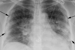 2020 09 17 23 43 8162 2020 09 03 Chest Xray Covid Fig1 400