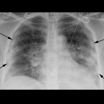 2020 09 17 23 43 8162 2020 09 03 Chest Xray Covid Fig1 400