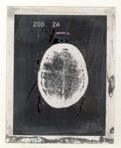 Polaroid image of the first clinical CT scan shows a large cystic lesion in the left frontal lobe.