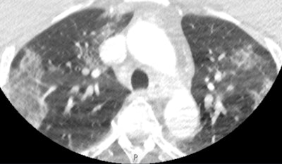 This scan shows apical ground-glass opacification in a patient with COVID-19. Despite the movement artifact that is not uncommon in acute stroke CT angiography, the biomarker is clearly present, alerting the treating team immediately that the patient has a high probability of COVID-19.
