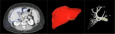 Volume calculation on 3D VR images. The liver is defined as the region of interest (left), and the Volume Computer Assisted Reading (VCAR) software extrapolates the defined region to additional CT slices. The VR Compare application can then calculate the volume of the entire liver (center) or an individual structure, such as the portal vein (right).