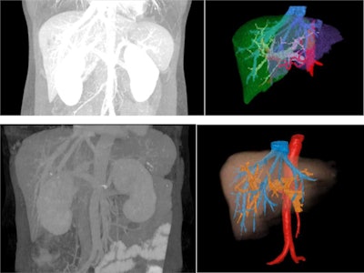 Comparison MIP and 3D VR images from two patients with hepatic malignancy. The borders of the overlapping portal and hepatic vessels are the same intensity in the monochromatic MIP images, but smaller vessels can be clearly visualized. The overlapping hepatic and portal veins and their branches can be delineated on the color-enhanced 3D VR images.