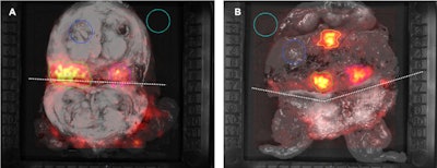 Grayscale photographic images overlaid with Cerenkov luminescence imaging signals. Incised prostate gland specimen of patient number 1 (A) and 2 (B). In each image, the regions of interest (ROIs) are encircled. The incision is marked with a dotted line. The light blue ROI (area of empty specimen tray) and dark blue ROI (area of normal prostate tissue) were used as empty background and tissue background, respectively. The green ROI (lesion 1) and pink ROI (lesion 2) show an increased signal; histopathological analysis confirmed cancer tissue in these areas. The orange ROI in image B tshows an increased signal from an area without cancer cells. Images created by Christopher Darr, PhD, and Dr. Ina Binse, University Medical Center Essen. Images courtesy of the Society of Nuclear Medicine and Molecular Imaging (SNMMI).