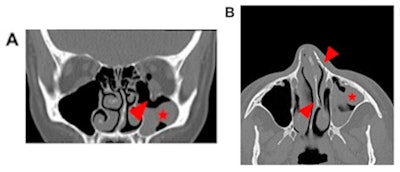 Case 1: A 42-year-old female presenting with diplopia after she reported having been punched by her partner in the face. Head CT revealed a left orbital floor fracture (arrowhead, A), blood-filled left maxillary sinus (asterisk, A, B), and nasal bone fractures as well as a nasal septum fracture (arrowhead, B) with deviation of the nasal septum to the left (arrowhead, B). The patient initially reported that she had run into a cupboard. Careful questioning indicated that she was attacked by her life partner. A social worker and, later, the police were informed. Images and caption courtesy of European Radiology.