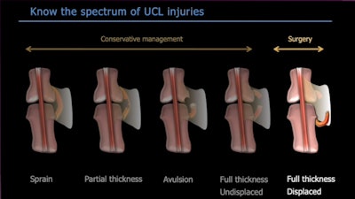 Radiologists must be familiar with the spectrum of ulnar collateral ligament injuries.