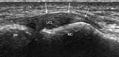 Coronal ultrasound image along the ulnar aspect of the thumb MCP joint shows the normal UCL as a convex echogenic fibrillar band (UCL) bridging the joint between the metacarpal head (MC) and first proximal phalanx (PP). The adductor aponeurosis is seen as a thin curvilinear echogenic structure (arrows) overlying the UCL. All images courtesy of Dr. Catherine McCarthy.