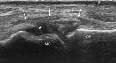 Coronal ultrasound image along the ulnar aspect of the thumb MCP joint of an undisplaced UCL tear. The ligament is diffusely thickened and hypoechoic with a cleft extending through its proximal aspect (asterisk). The ligament remains symmetrically centred over the MCP joint and deep to adductor aponeurosis (arrows).