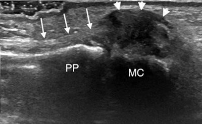 Coronal ultrasound image along the ulnar aspect of the thumb MCP joint demonstrates a displaced UCL tear or Stener lesion. The proximally retracted UCL appears as a heterogeneous mass (arrowheads) adjacent to the metacarpal head (MC) which is displaced proximal and superficial to the adductor aponeurosis (arrows).