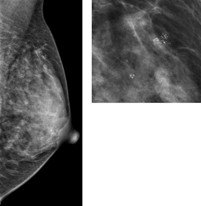 Benign breast disease, as seen on mammography. Images courtesy of Marta Román, PhD.