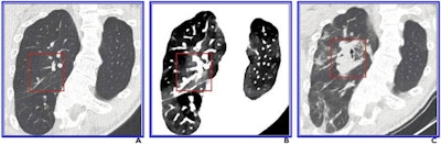 A 41-year-old autistic woman with major scoliosis and COVID-19. (A) Initial conventional axial CT image shows no noticeable lung damage (within red box) in right upper lobe. (B) Electron-density spectral CT image obtained at the same time as the image in A shows lesions (within red box) in the right upper lobe. (C) Follow-up conventional axial chest CT image obtained five days after images in A and B confirm the presence of lesions (within the red box) in the right upper lobe. Images and caption courtesy of the ARRS.