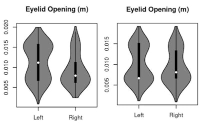 First figure: Example of a violin plot showing that the reader has more data points with larger eyelid apertures (mean greater than 12 mm) in the first two hours of reading than in the last two hours. Second figure: Violin plot of a participant's third hour, showing more data points with less than 10 mm of eye aperture. After 1.5 hours of reading, participants had more data points with smaller eye apertures.