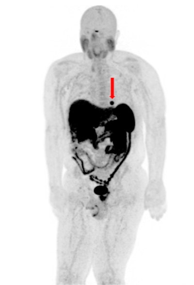 Maximum intensity projection image of Ga-68 DOTATATE PET demonstrates focally increased tracer uptake in a metastasis involving the interventricular septum (arrow). Low-grade uptake seen within the bilateral inguinal lymph nodes was reactive. All images courtesy of Dr. John Renfrew, Mayo Clinic in Arizona.