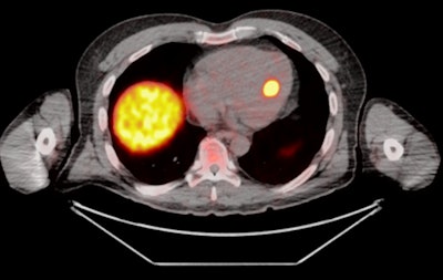 Axial Ga-68 DOTATATE PET/CT image for the same patient demonstrates the focal tracer uptake localized to the interventricular septum (maximum standardized uptake value [SUVmax] = 24).