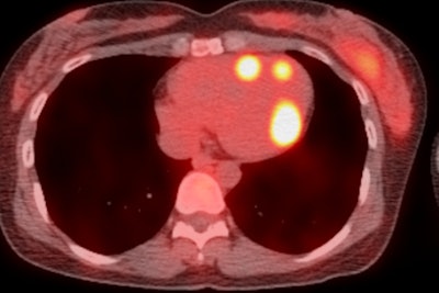 Ga-68 DOTATATE PET/CT image for a patient with a neuroendocrine metastasis in the right ventricle, ventricular apex, and left ventricular free wall.