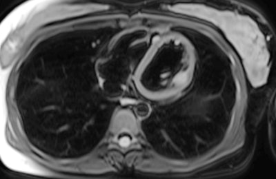 T2 fat-suppressed axial MRI of same patient demonstrates increased T2 signal within the cardiac metastases. The lesions also showed restricted diffusion.