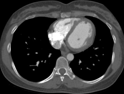 Contrast-enhanced chest CT of same patient demonstrates three filling defects corresponding to the neuroendocrine metastases seen on Ga-68 DOTATATE PET/CT and cardiac MRI. This was the only patient demonstrating a correlate on CT.
