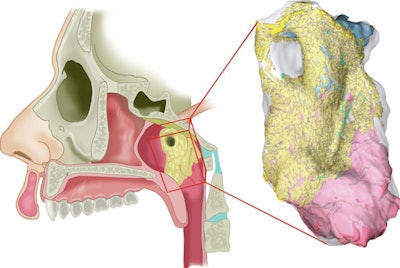 An interactive 3D reconstruction of histological slides of the newly identified gland. Schematic representation of region of the torus tubarius with overlying gland, in its anatomical setting (left) and as 3D histology reconstruction (right). The glandular tissue is shown in yellow (acini) and light blue (ducts). The dorsomedial view shows how the tubarial gland relates to the underlying torus tubarius cartilage (dark blue) and muscle (pink).