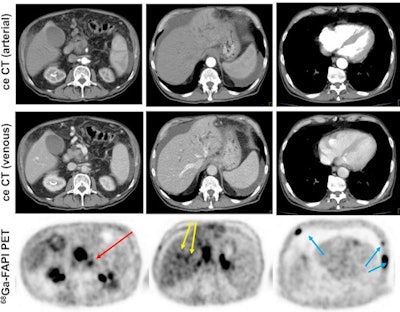 Contrast-enhanced CT (ceCT) and FAPI-PET/CT (68Ga-FAPI-PET) images from the same patient with local disease recurrence. In contrast to CT, FAPI-PET/CT discriminates a metastatic lymph node from the local recurrence mass (red arrow). FAPI-PET/CT also reveals possible new liver (yellow arrows) and bone (blue arrows) metastases. Images courtesy of Journal of Nuclear Medicine.
